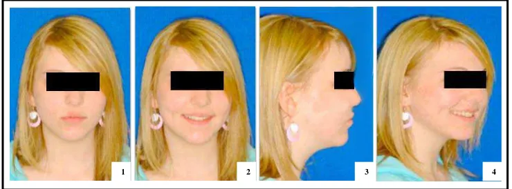 Gambar 1.  Fotografi intra oral. (1) Foto pandangan anterior gigi dalam  keadaan oklusi, (2) Foto pandangan bukal gigi geligi sebelah kanan dalam keadaan oklusi, (3) Foto pandangan bukal gigi geligi sebelah kiri dalam keadaan oklusi, (4) Foto oklusal rahang atas, (5) Foto oklusal rahang bawah.17 