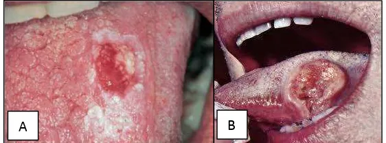 Gambar 6. Kanker rongga mulut. (A) Tahap awal pertumbuhan kanker pada lidah, (B) Perkembangan   lebih lanjut dari kanker rongga mulut27 