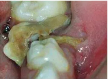 Gambar 4. Fistula di sisa akar gigi 85 dan pada gigi 261,30