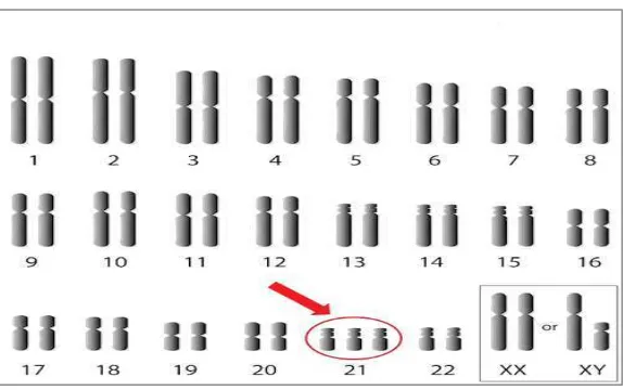 Gambar 1. Kromosom pada sindrom Down1 