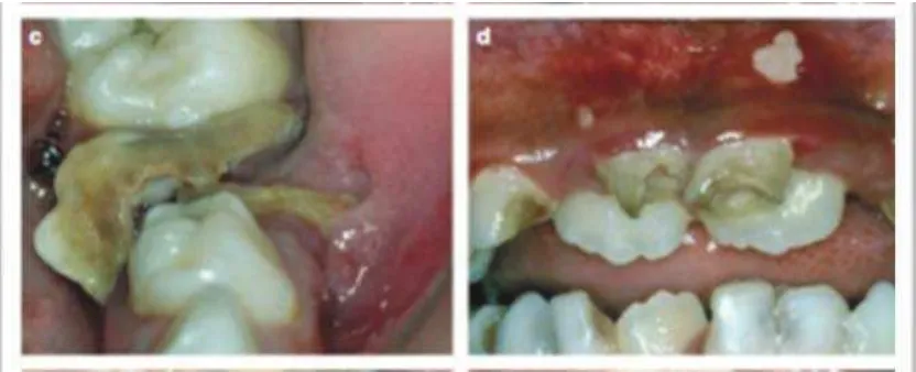 Gambar  2. (a dan b) Keterlibatan pulpa p, kamar pulpa terlihat atau koronal gigi telah hancur oleh proses karies dan hanya akar atau sisa akar yang tertinggal 15 