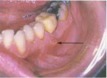 Gambar 2. Ulserasi18 