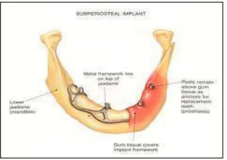 Gambar 1. Implan subperiosteal. (Anonymous. Subperios- teal implant. <httpwwww.google.co.id> (20 Nov 2011)
