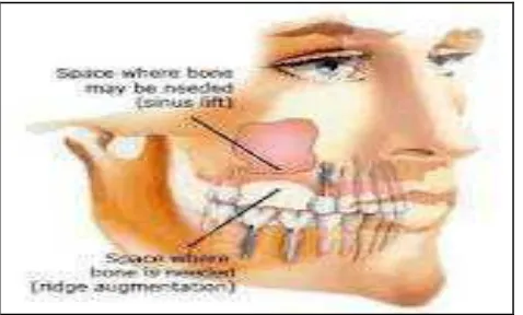 Gambar 5. Letak sinus maksilaris terhadap akar gigi. 