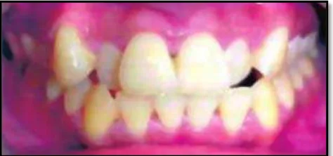 Gambar 1. Klas I Angle dengan gigi anterior berjejal (crowding)2 