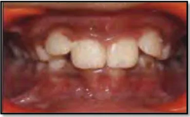 Gambar 4. Deep bite anterior2  