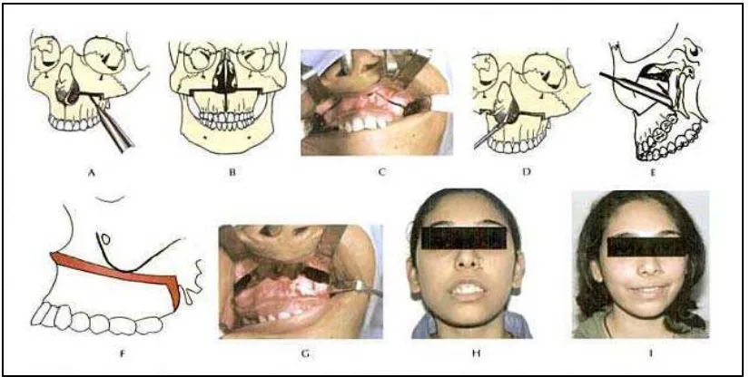 Gambar 9. Osteotomi Le Fort I impaksi : (A) pemotongan osteotomi, (B), (C) pemotongan osteotomi pada kedua sisi, (D) osteotomi nasoseptal yang digunakan untuk memisahkan tulang nasal dari maksila, (E) pemisahan maksila dari lapisan pterigoid, (F), (G) pemi