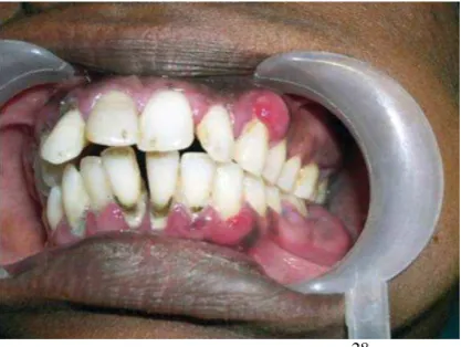 Gambar 1. Periodontitis28