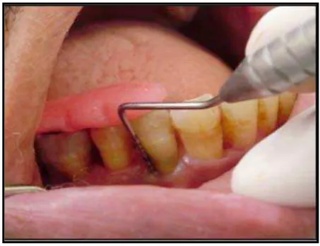 Gambar 5. Pemeriksaan jaringan periodontal menggunakan prob periodontal UNC 15 