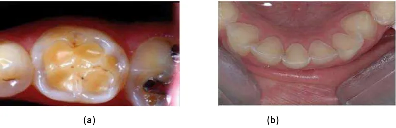 Gambar 1. Erosi gigi pada permukaan (a) oklusal dan (b) lingual pada pasien GERD 