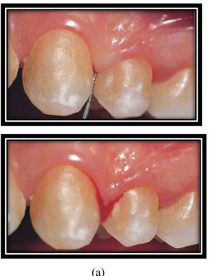 Gambar 2. Perdarahan saat probing (a) Probing pada gingiva yang mengalami oedematus akibat gingivitis, (b) terjadinya perdarahan setelah dilakukan probing.18 