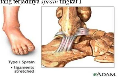 gambar tentang terjadinya sprain tingkat I. 