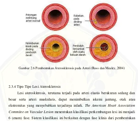 Gambar 2.6 Pembentukan Aterosklerosis pada Arteri (Ross dan Mealey, 2004) 