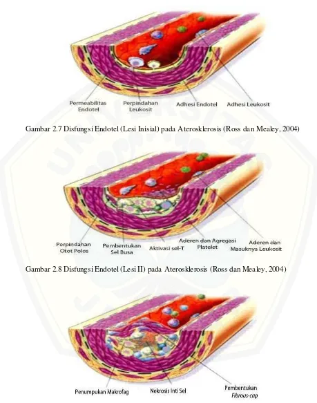 Gambar 2.7 Disfungsi Endotel (Lesi Inisial) pada Aterosklerosis (Ross dan Mealey, 2004) 