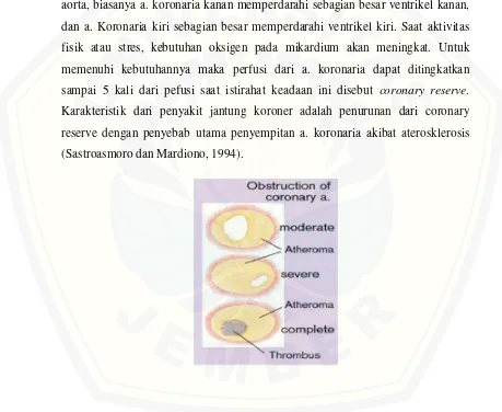Gambar 2.4. Obstruksi pada arteri korona 