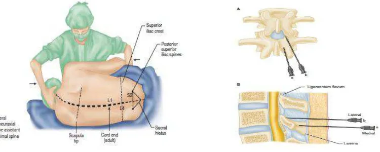 Gambar 3. Anatomi Anestesi Spinal dan Lapisan Tulang Vertebra  Saat Tindakan Anestesi Spinal58 