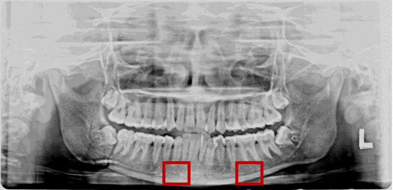 Gambar 1 Citra medis dental panoramic radiograph  