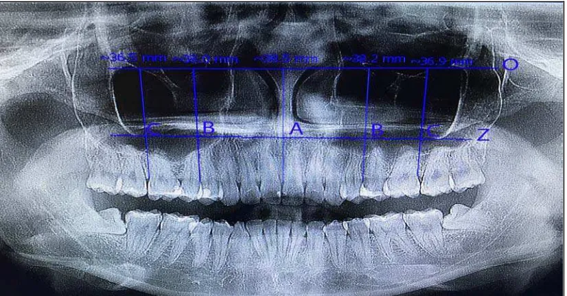 Gambar 7.  Pengukuran  ketinggian  maxillary alveolar ridge pada wanita bergigi. Garis O-                       garis  infraorbital;  garis  Z–garis  zigomatik;  garis A, B, C–garis O ke alveolar                      crest  (1,2  mm  dari  cementoenamel  junction)  pada  midline rahang  atau titik                      tengah kedua insisif sentral (A), distal  premolar  pertama  (B) dan  distal molar                      pertama (C) pada regio kanan dan kiri (arsip pribadi) 