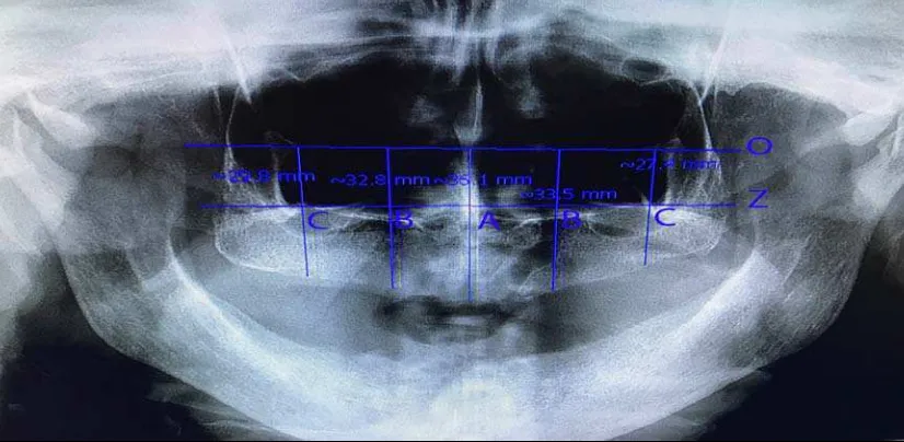 Gambar 8. Pengukuran ketinggian                      (B) dan  titik  molar  pada  titik  inferior maxillary alveolar ridge pada wanita edentulus.Garis O-                     garis  infraorbital; garis Z-garis  zigomatik;  garis A,  B, C-garis  O ke  alveolar                      crest pada midline rahang berpedoman pada septum nasi, foramen nasopalatina                      dan  anterior nasal  spine (A), titik  premolar  pada  mesial foramen  infraorbita   processus  zygomaticus  (C) pada regio                      kanan dan kiri (arsip pribadi)  