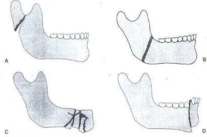 Gambar 2-7. Tipe fraktur mandibula. A. Greenstick B. Simple C. Comminuted  D. Compound
