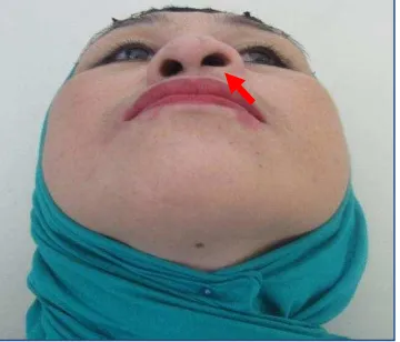 Gambar 1: Foto pasien dari depan sebelum operasi tampak kista nasolabial di bawah ala nasi kiri