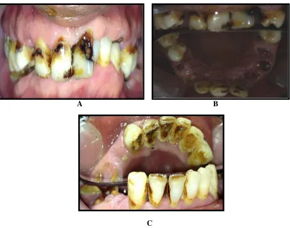 Gambar 4.1 Gambar kondisi rongga mulut subjek laki-laki berusia 52 tahun.                A