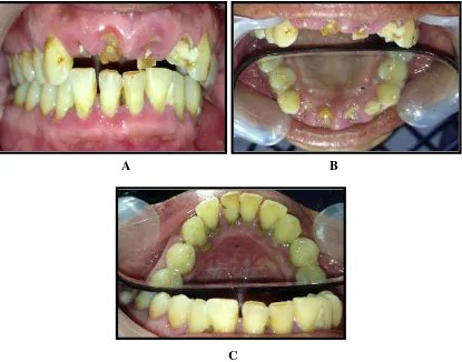 Gambar 4.2 Gambar kondisi rongga mulut subjek perempuan berusia 26 tahun.           A