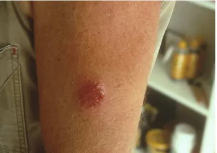 Figure 2. Ringworm caused  by arm.T. verrucosum on a human    