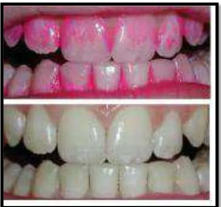Gambar 2. Plak gigi dengan pewarnaan      disclosing solution.26 