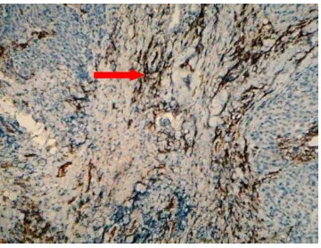 Gambar 2. Pewarnaan dengan CD 31 yang terekspresi dengan warna 