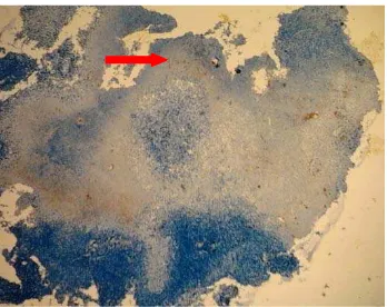 Gambar 5. Pewarnaan immunohistokimia TNF-αskor +3 (pewarnaan 