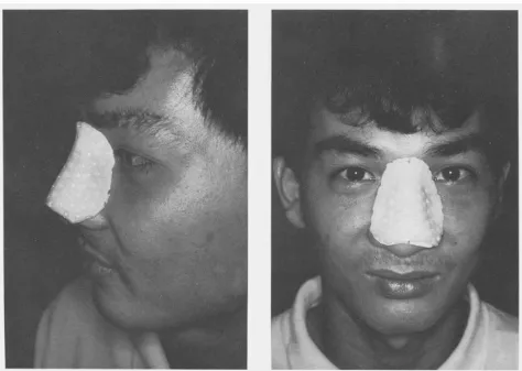 Figure I-Patient with nasal splint. 