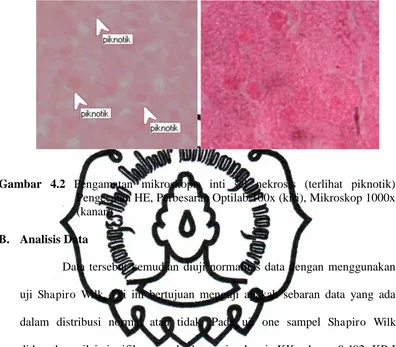 Gambar 4.2  Pengamatan mikroskopis inti sel nekrosis (terlihat piknotik) Pengecatan HE, Perbesaran Optilab 100x (kiri), Mikroskop 1000x 