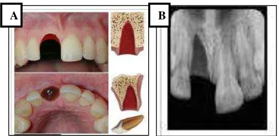 Gambar.1 A.Gambaran klinis soket gigi yang avulsi  B. Gambaran radiografi keadaan gigi yang avulsi16 