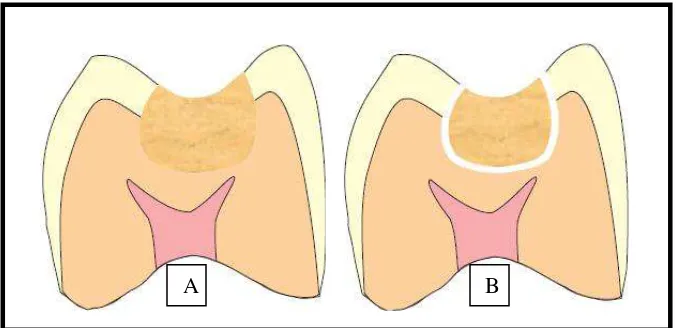 Gambar 2.A. Gigi yang baru direstorasi, sebelum polimerisasi,  B. Pembentukkan marginal gap setelah restorasi.19