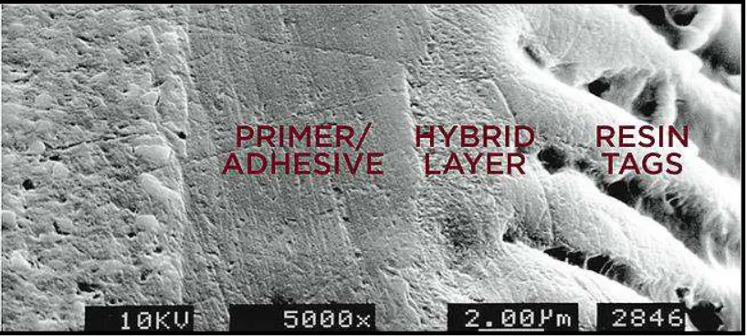 Gambar 6.Hybrid layer membentuk adhesive interface, lapisan ini membentuk  ikatan yang menghubungkan jaringan gigi dan bahan restorasi11 