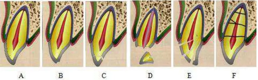 Gambar 1.Kerusakan pada jaringan keras gigi dan pulpa: A. Retak mahkota  B. Fraktur enamelC