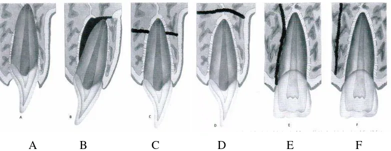 Gambar 3. Kerusakan pada jaringan pendukung:  A. Kerusakan soket alveolar maksila dan mandibula  B
