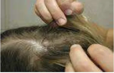 Gambar.2.4. Pemeriksaan kutu kepala di rambut dan kulit kepala                                              Sumber: CDC, 2010 