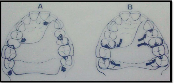 Gambar 3. A Bila basis gigi tiruan berjalan melewati tepi gingiva, sudut antara gigi tiruan  dan tepi gingiva harus tumpul B