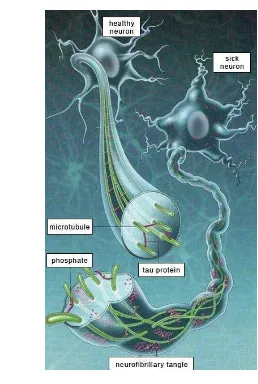 Gambar 2 Neurofibriallary tangles pada penderita Alzheimer 
