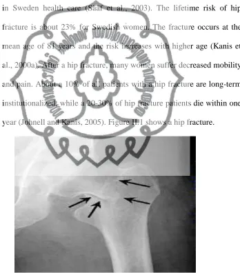 Figure II.4 A Hip Fracture 