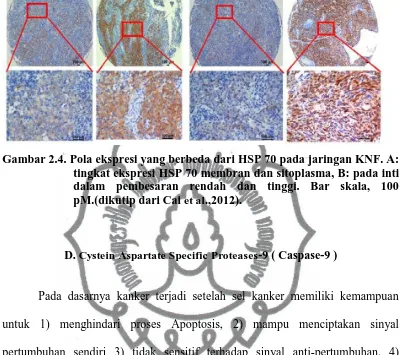 Gambar 2.4. Pola ekspresi yang berbeda dari HSP 70 pada jaringan KNF. A: tingkat ekspresi HSP 70 membran dan sitoplasma, B: pada inti 