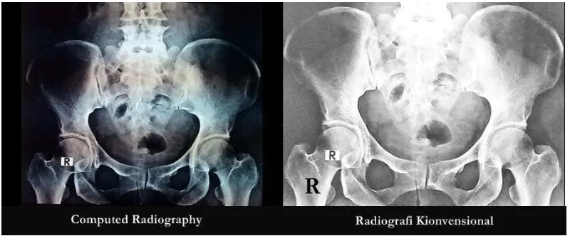 Gambar 4.6 Perbandingan Hasil Foto Rontgen Computed Radiography (CR) 