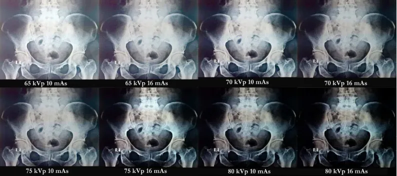 Gambar 4.1 Citra Radiografi Pelvis AP 