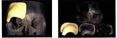 Gambar-8  Dari kiri kekanan: Gambar yang didapat dari CT scanner dan Model medis dibuat dengan menggunakan Stereocol resin [Pham 2001]  