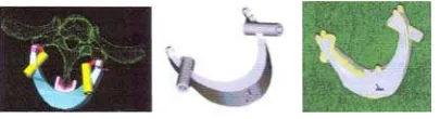 Gambar-12   Model Computer alat bantu penuntun bor bedah gigi (dental drilling guide) [Lorrison 2001]  