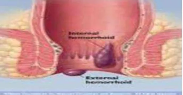 Gambar 6.5. Keadaan hemoroid 