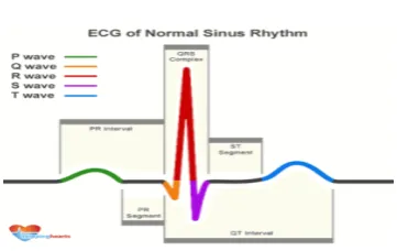 Gambar 1.5 EKG Normal 