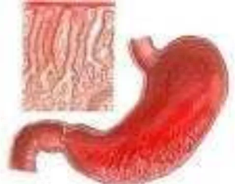 Gambar 1: iritasi pada dinding lambung (gastritis) 